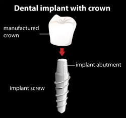 Dental Implants | Kenneth Yates DDS | Beverly Hills, CA 90212